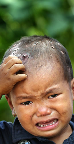 震災直後にできた湿疹が治らないままの頭をかきむしるサンデス・タパちゃん。村の衛生状態は悪化し、薬品不足が続いている＝ボテシパ村で２０１５年９月５日、幾島健太郎撮影
