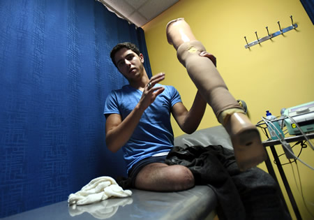 病院で義足を取り付けるアブドゥルサラーム・アルハリーリさん。砲弾の破片で右脚を切断した＝アンマンで