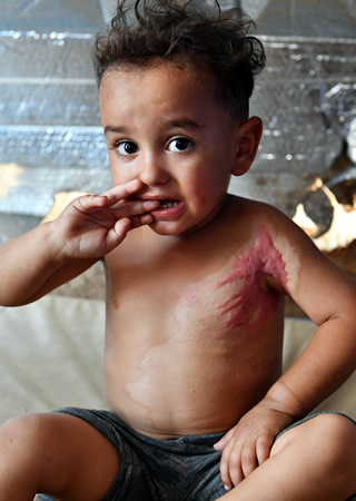 避難先のキャンプでやけどを負った２歳の男の子＝イラク・ニナワ県のハゼルＭ１キャンプで２０１８年８月１５日木葉健二撮影